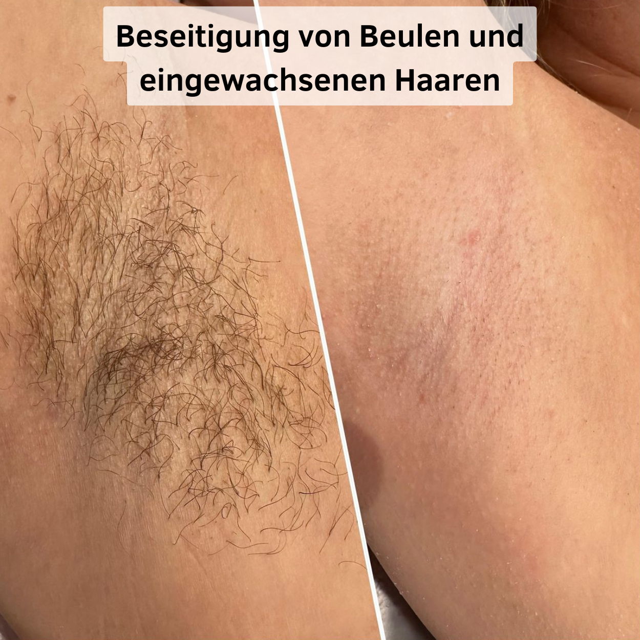 SilkGlide Pro™ | Glätte erzeugen!